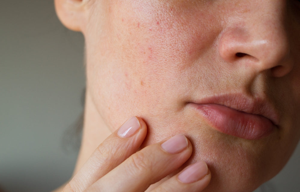 How To Heal Irritated Skin After Travel Or Climate Changes